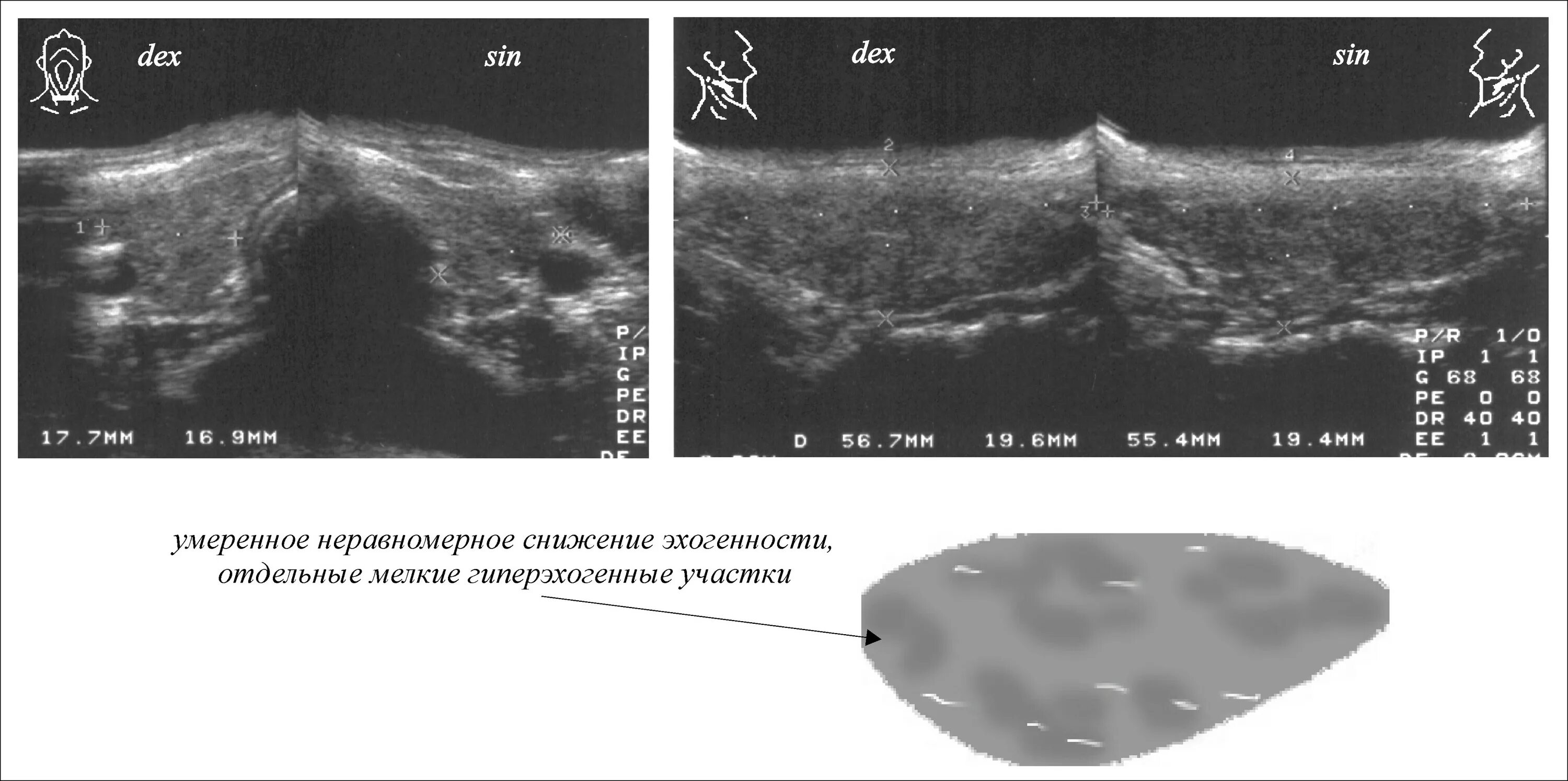 Эхоструктура щитовидной железы. Эхоструктура неоднородная щитовидной железы что это такое. Мелкозернистая эхоструктура щитовидной железы. Диффузно неоднородная структура что это значит