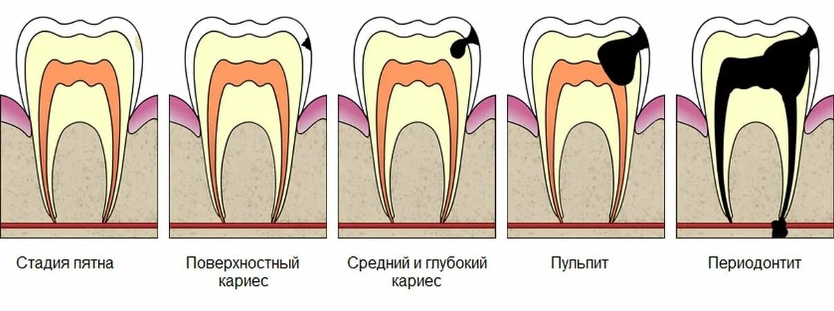 Осложнения лечения пульпита. Кариес пульпит периодонтит.