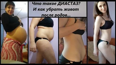 Как убрать живот после родов форум