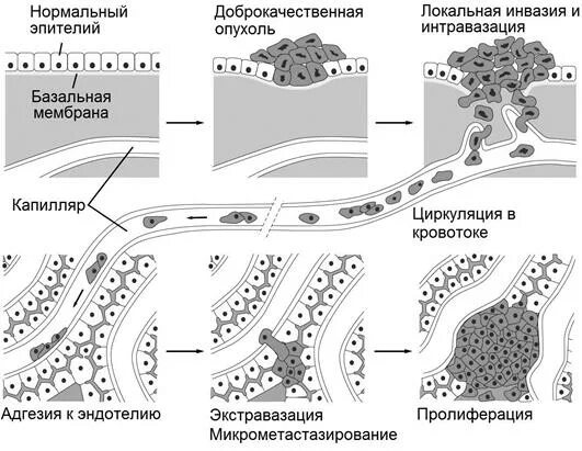 Схема метастазирования опухоли. Стадия инвазивного роста опухоли. Инвазивный рост опухоли схема. Метастазирование опухолей патанатомия.