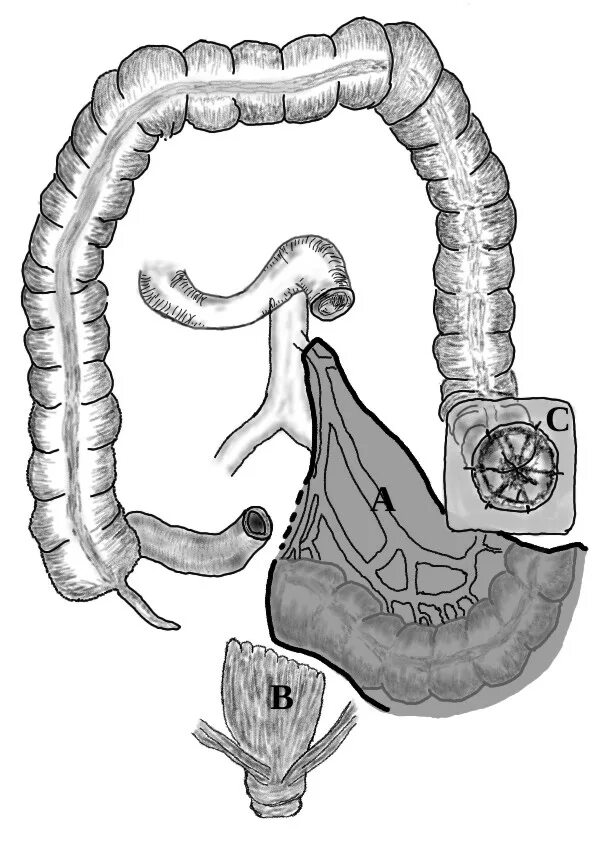 Колостома операция Гартмана. Колостома сигмовидной кишки. Операция Гартмана (Хартмана). Колостома -Стома толстой кишки.. Сигма кишечника