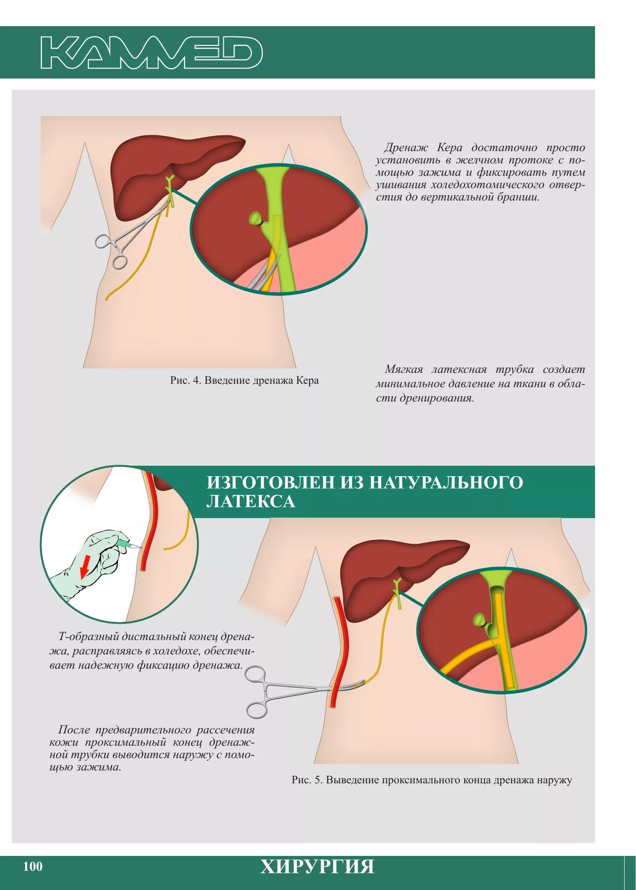 Осуществление ухода за дренажом. Сколько носить дренаж. Сколько носить дренаж. Двухпросветные трубки для дренирования. Особенности ухода за дренажами.