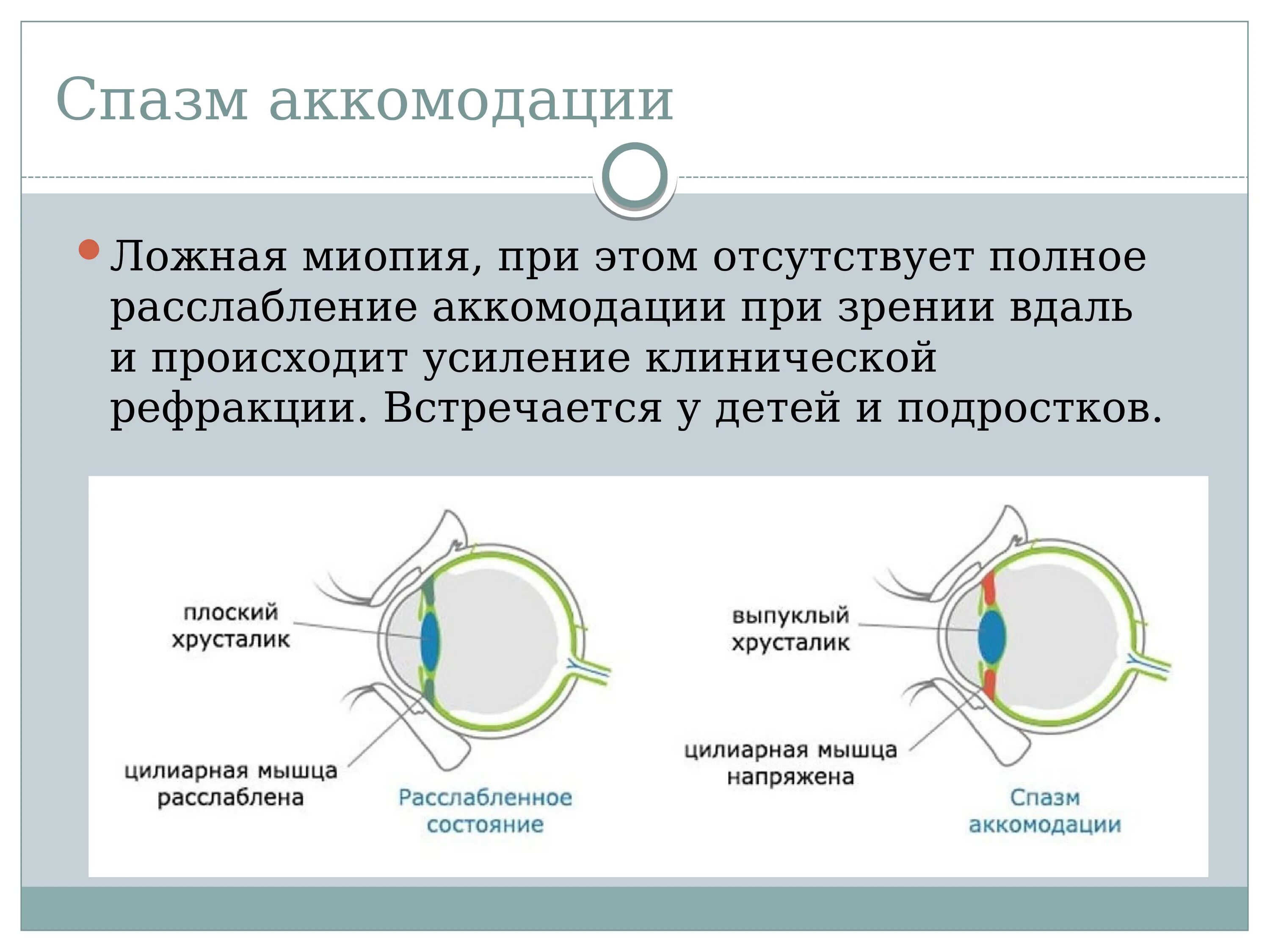 Снятие спазма аккомодации. Спазм аккомодации глаз. Спазм аккомодации ложная близорукость. Сразм АК. Спазм глазных мышц.