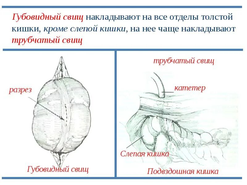 Свищи кишечника после операции. Губовидные и трубчатые свищи. сформированные кишечные свищи.