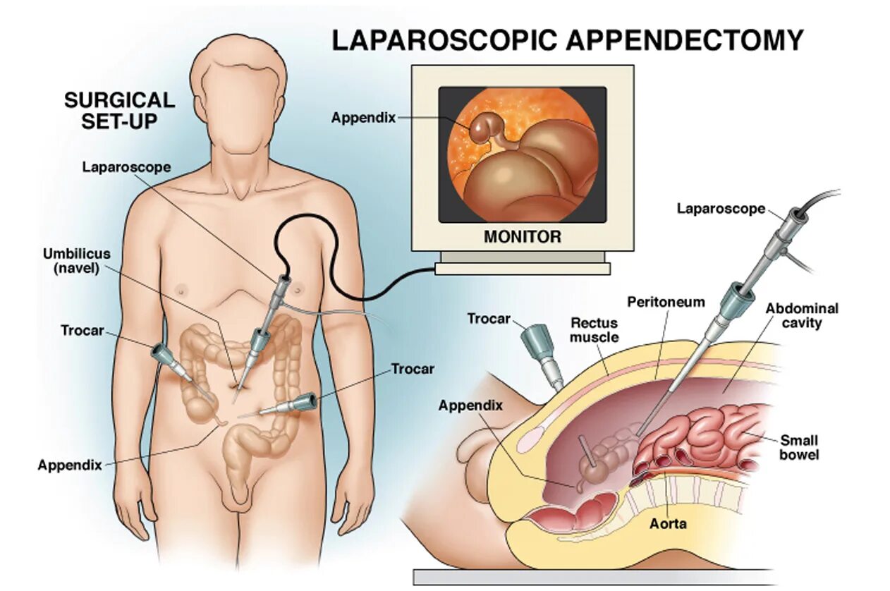 Лапароскопическая аппендицит аппендэктомия. Диагностическая лапароскопия острый аппендицит. Лапароскопическая аппендэктомия червеобразный отросток. Лапароскопическая аппендэктомия дренирование брюшной полости.