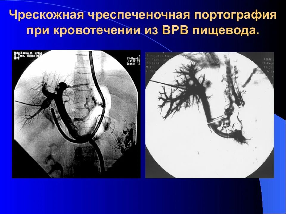 Кровотечения пищевода печени. Расширение вен пищевода рентген. Портография при портальной гипертензии. ВРВП -варикозное расширение вен пищевода. Портальная гипертензия варикозное расширение вен пищевода.