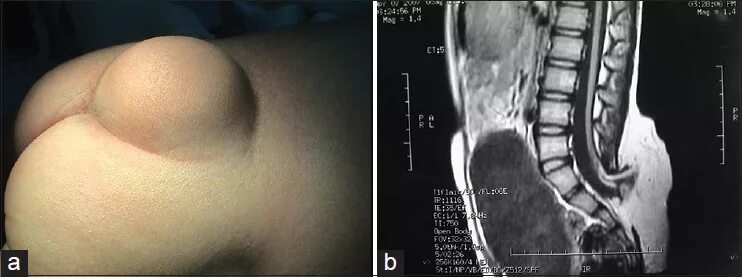 Мрт поясничного отдела позвоночника l5-s1. Запирательное отверстие топография. Бедренный канал топографическая анатомия. Топография пахового канала анатомия. Паховая и бедренная грыжа.