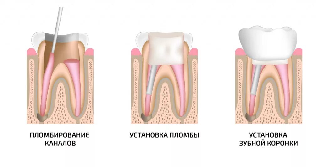 Этапы установления коронки на зуб. Штифтовая вкладка коронка. Как устанавливается коронка на штифт. Как устанавливается пломба с штифтом.