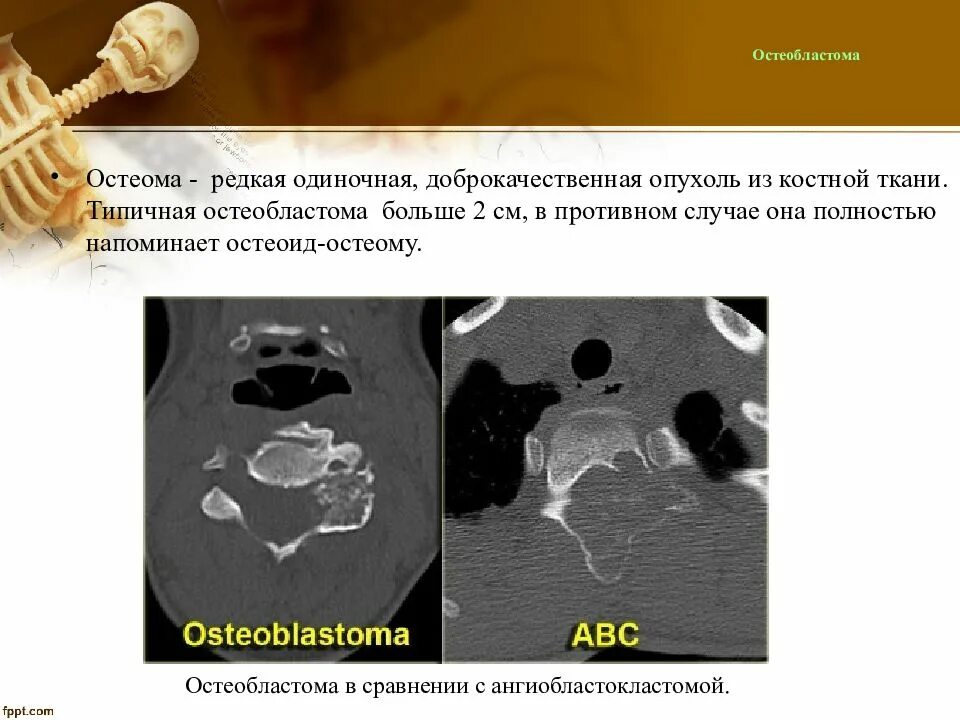 Доброкачественная остеома. Доброкачественная остеома. Доброкачественная остеома. Злокачественная опухоль костной ткани. Остеома доброкачественная рентген.