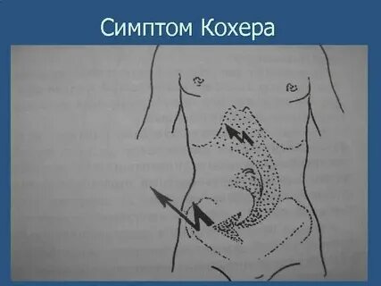 Где находится аппендицит справа или слева