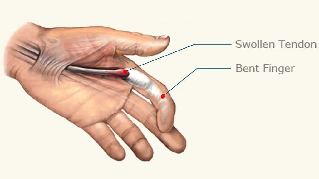 Теносиновит сухожилия кисти. Тендовагинит сгибателей кисти. Крепитирующий тендовагинит кисти. Стенозирующий лигаментит (болезнь Нотта или «щелкающий» палец);.