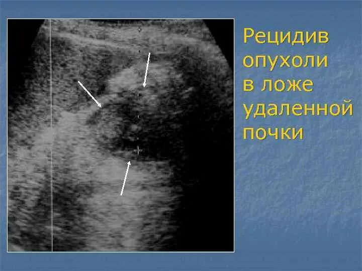 Новообразования почки на УЗИ. Объемное образование в почке на УЗИ что это.