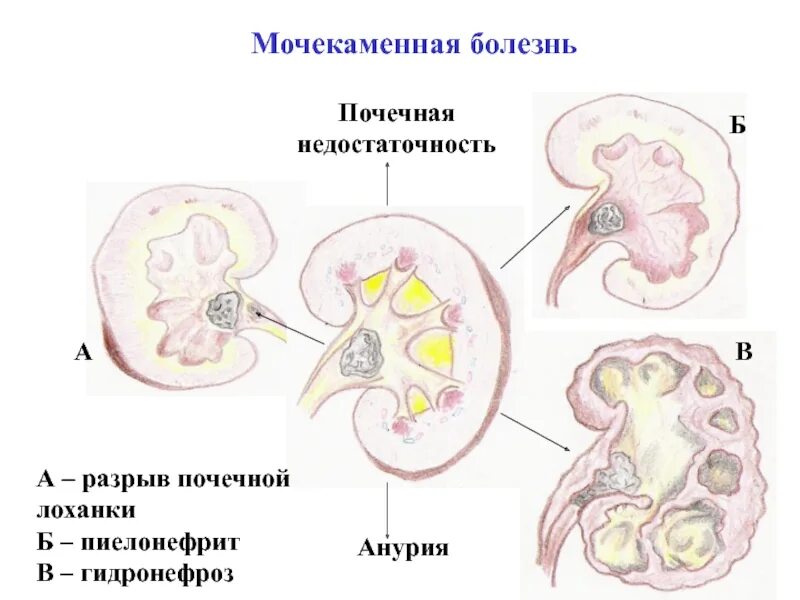Поступление мочи в почечную лоханку
