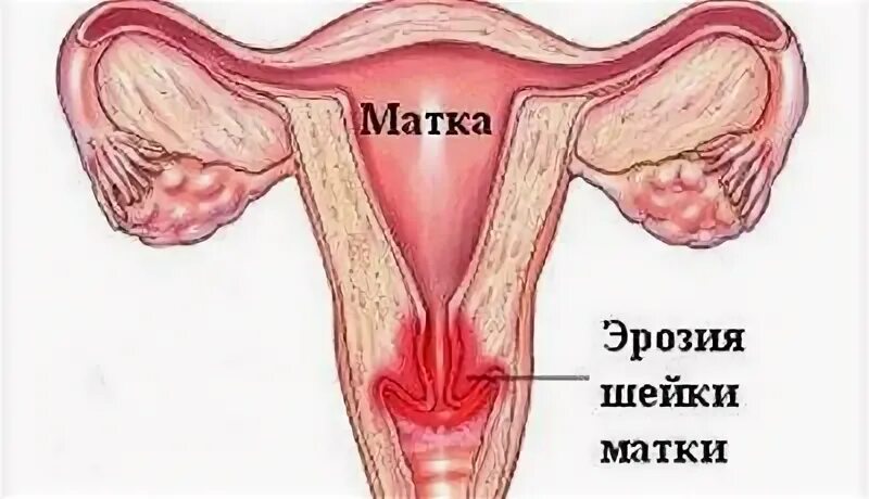 Цервикоз шейки матки. Псевдоэрозия шейки матки. шейка матки при эрозии.