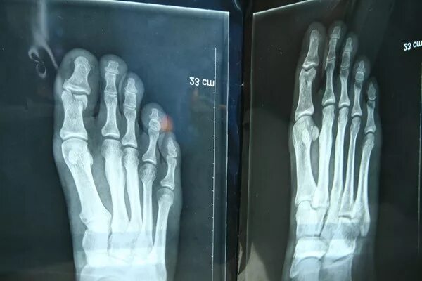 Перелом фаланги 5 пальца стопы рентген. Оскольчатый перелом пальца ноги рентген. Перелом проксимальной фаланги 1 пальца. Краевой перелом ногтевой фаланги 1 пальца. Перелом основной фаланги 1 пальца стопы рентген.