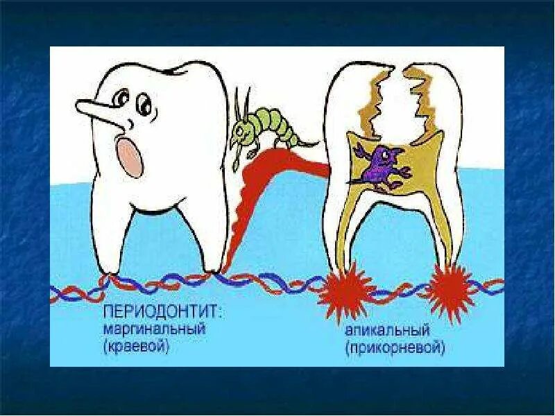 Рокс периодонт. Апикальный и маргинальный периодонтит. зуб маргинальный периодонтит. краевой и апикальный периодонтит.