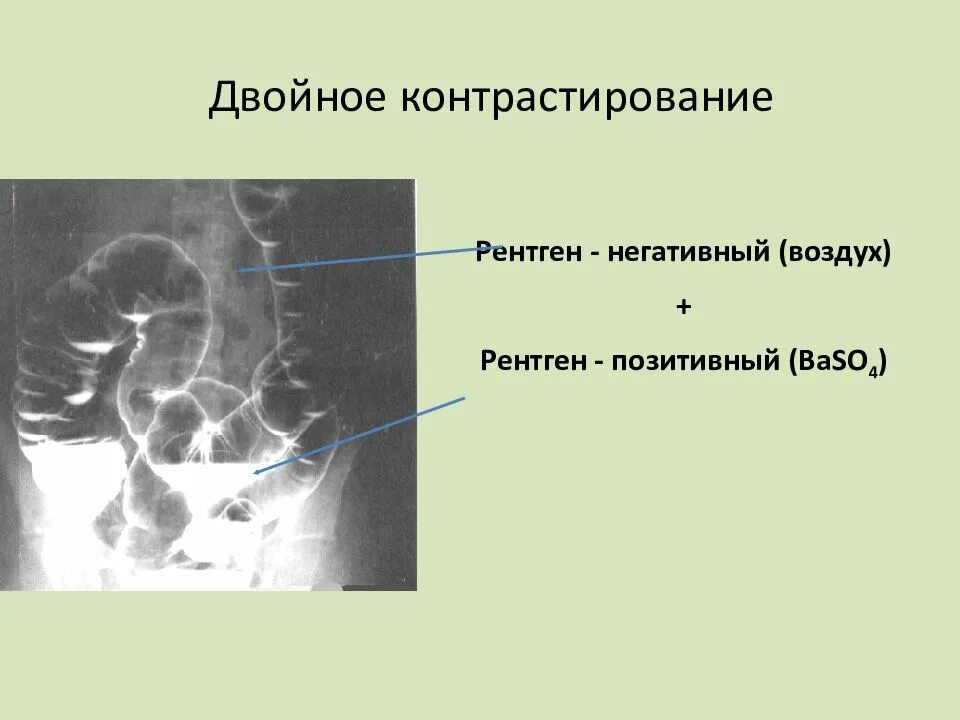 Как часто можно рентген. Рентген двойное контрастирование. рентген контрастирование. методика двойного контрастирования. методика двойного контрастирования желудка.