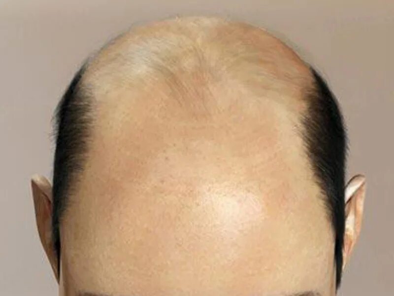 лысина у мужчин. лысина вид сверху.