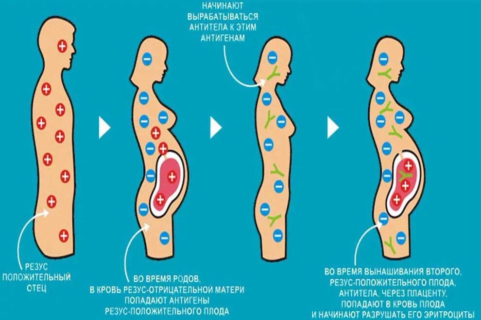 Схема развития резус конфликта. Резус-конфликт матери и плода схема. Резус конфликт схема. Последовательность стадий развития резус- конфликта. Резус конфликтной