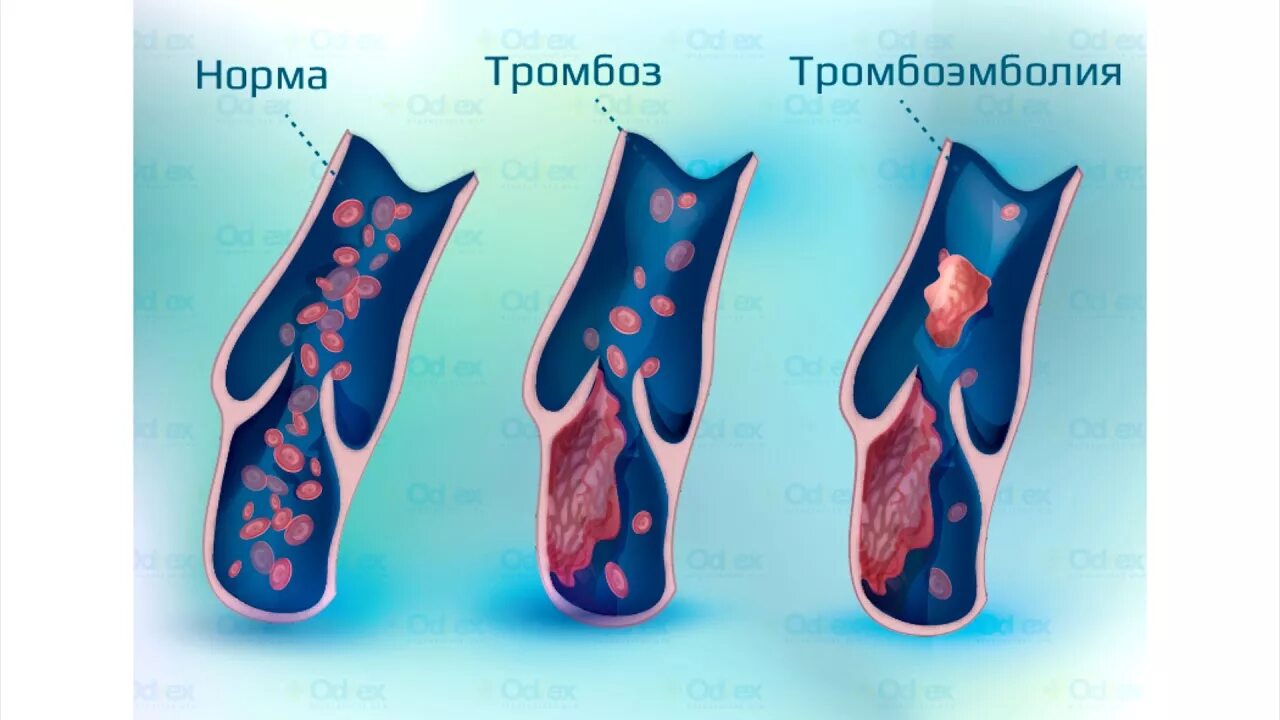 Тромбоз и тромбоэмболия. Тромбоз периферических сосудов. Эмболия тромбы