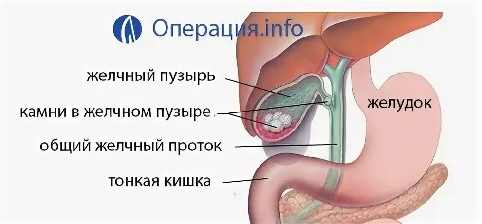 Удалили желчь. Удалили желчь. Вырезанный желчный пузырь. Удалили желчь. При удаленном желчном пузыре.