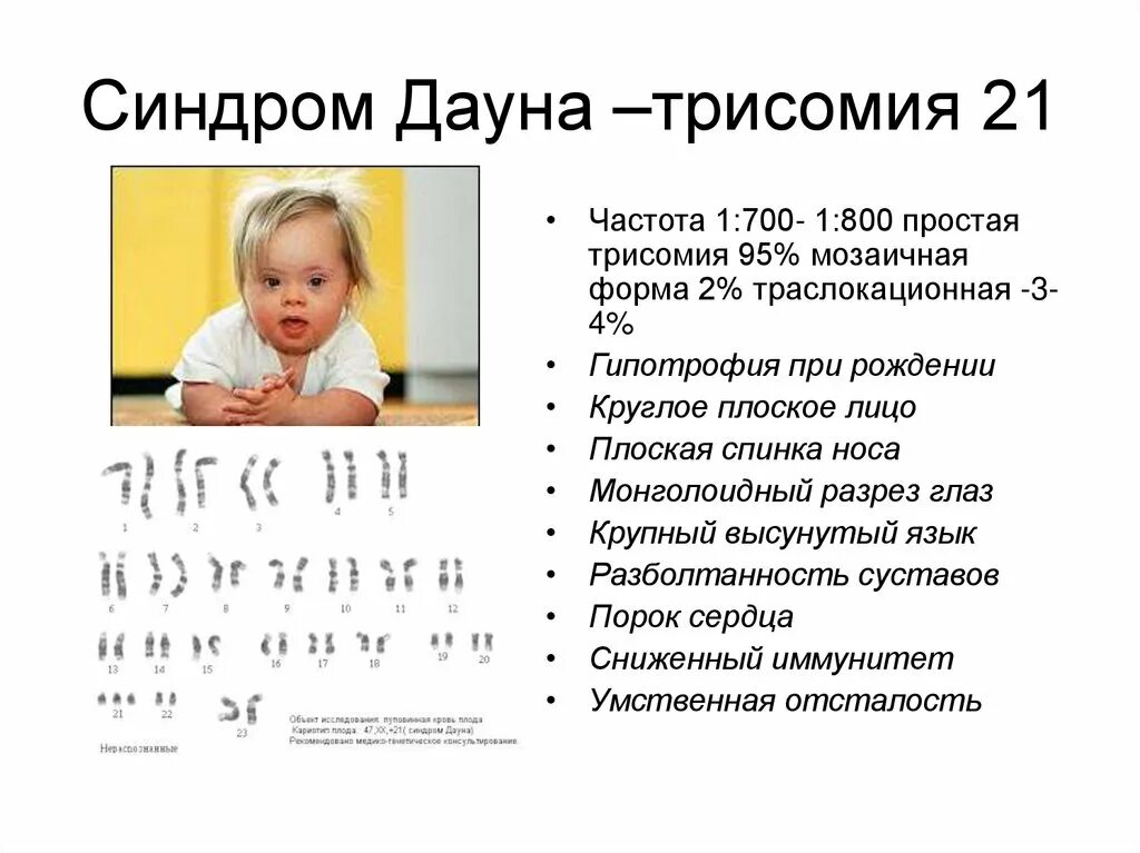 Синдром Дауна трисомия 21. Мозаичный синдром Дауна. Мозаичная форма синдрома Дауна. Мозаичнский синдром Дауна. Фенотип ребенка с синдромом дауна