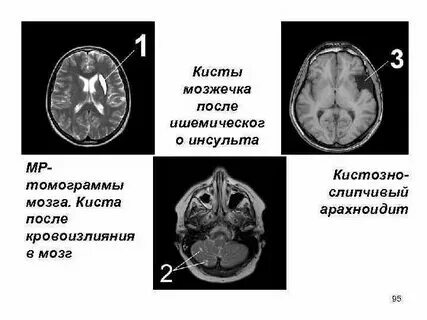 Кистозные образования головного мозга. Субэпендимальная киста. Дермоидная киста головного мозга кт. Арахноидальная киста эпифиза. Полость прозрачной перегородки головного мозга.