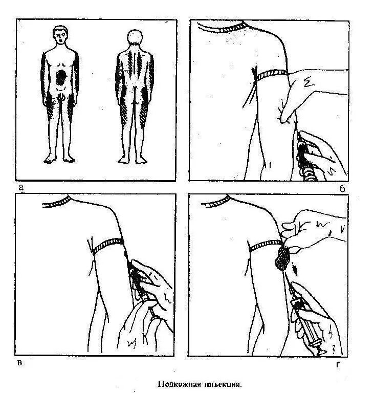 Подкожная инъекция алгоритм. Техника подкожной инъекции алгоритм. Алгоритм подкожной инъекции алгоритм. Алгоритм инъекций внутрикожно. Подкожные инъекции техника выполнения
