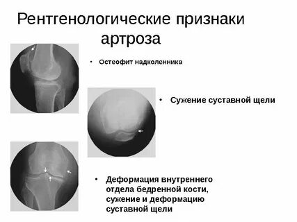Признаки остеофита