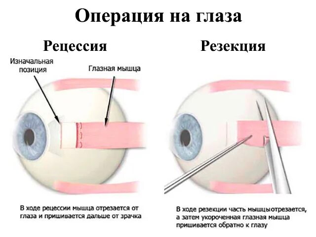 Исправление оперированного косоглазия. Операция по устранению косоглазия у детей. Склеропластика глаз после операции. Операции при косоглазии.