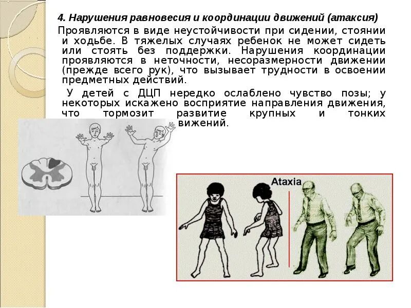 Нарушение координации движения причины. Нарушение равновесия и координации. расстройства равновесия и координации движений. нарушение координации движения. нарушения равновесия и координации при дцп – это:.