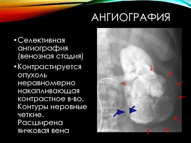 Почки контур. Парапельвикальные кисты почек на узи. Кт почек норма. Опухоль накапливающая контраст. Ампутация чашечки почки.