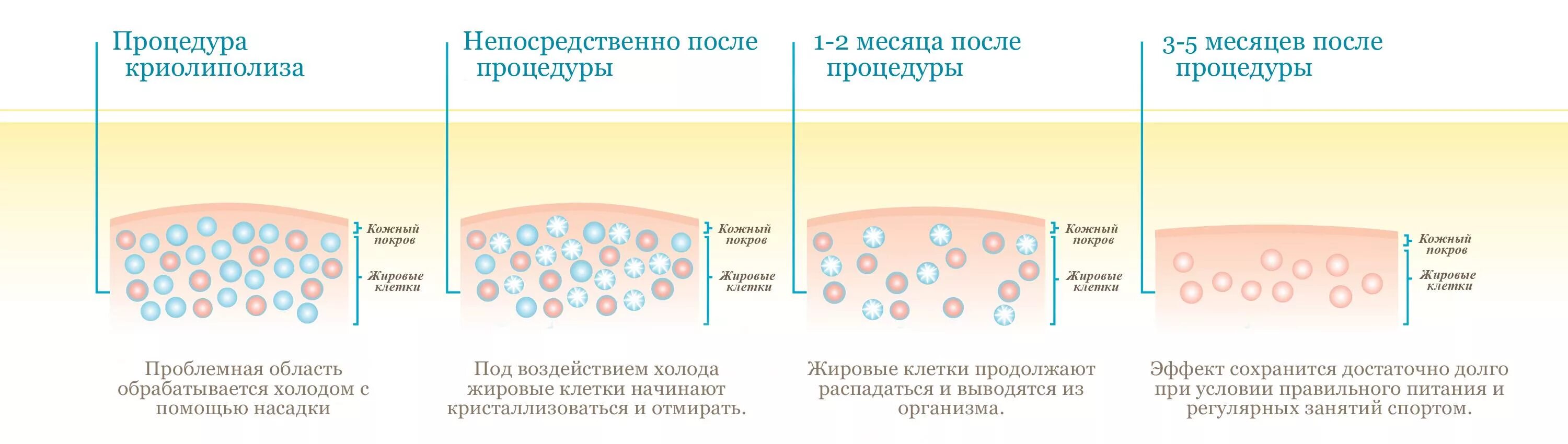 Криолиполиз что это отзывы. Криолиполиз жировой ткани. Кавитация жировых отложений. Принцип действия криолиполиза. Кавитация схема.