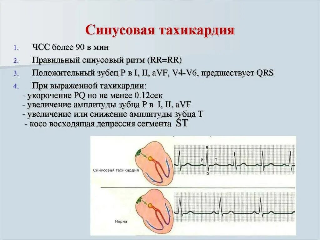 При учащении пульса длительность сердечного цикла. ЭКГ тахикардия синусовый ритм ЧСС 90. Синусовая аритмия с ЧСС. ЧСС при синусовой тахикардии. Тахикардия при синусовом ритме.
