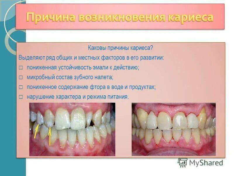 Кариес причины возникновения. Основная причина возникновения кариеса:. Неприятное ощущение на зубах