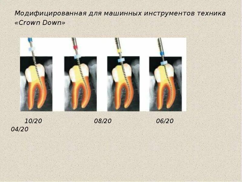 Обработка корневых каналов техники. Техника Step back в эндодонтии. Crown down техника в эндодонтии. Crown down и Step back. Методика Crown down в стоматологии.