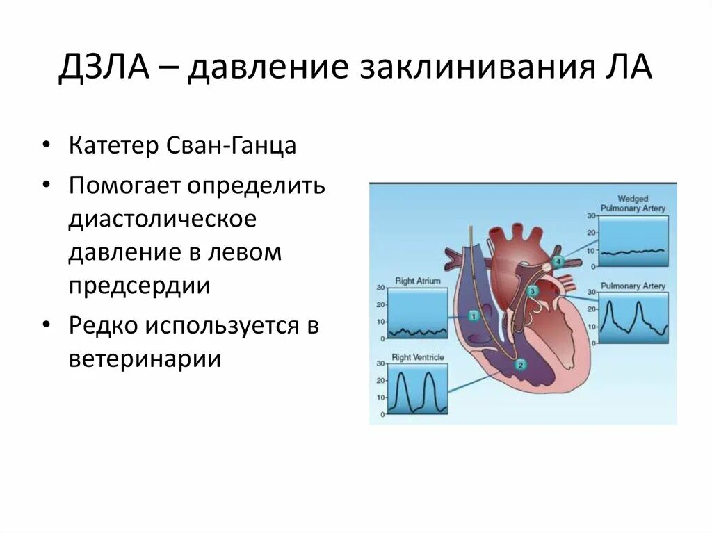 Давление в правом предсердии. Давление заклинивания легочной. ДЗЛА давление заклинивания легочной артерии. Заклинивание легочной артерии что такое. Давление заклинивания в легочной артерии расчет.