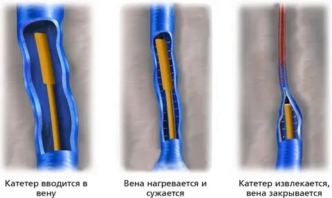 Лазерная подкожная коагуляция