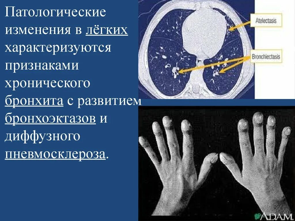 Патологические изменения в организме. Патологические изменения в легких. патологические изменения. антологические изменения. патологические изменения легкие.