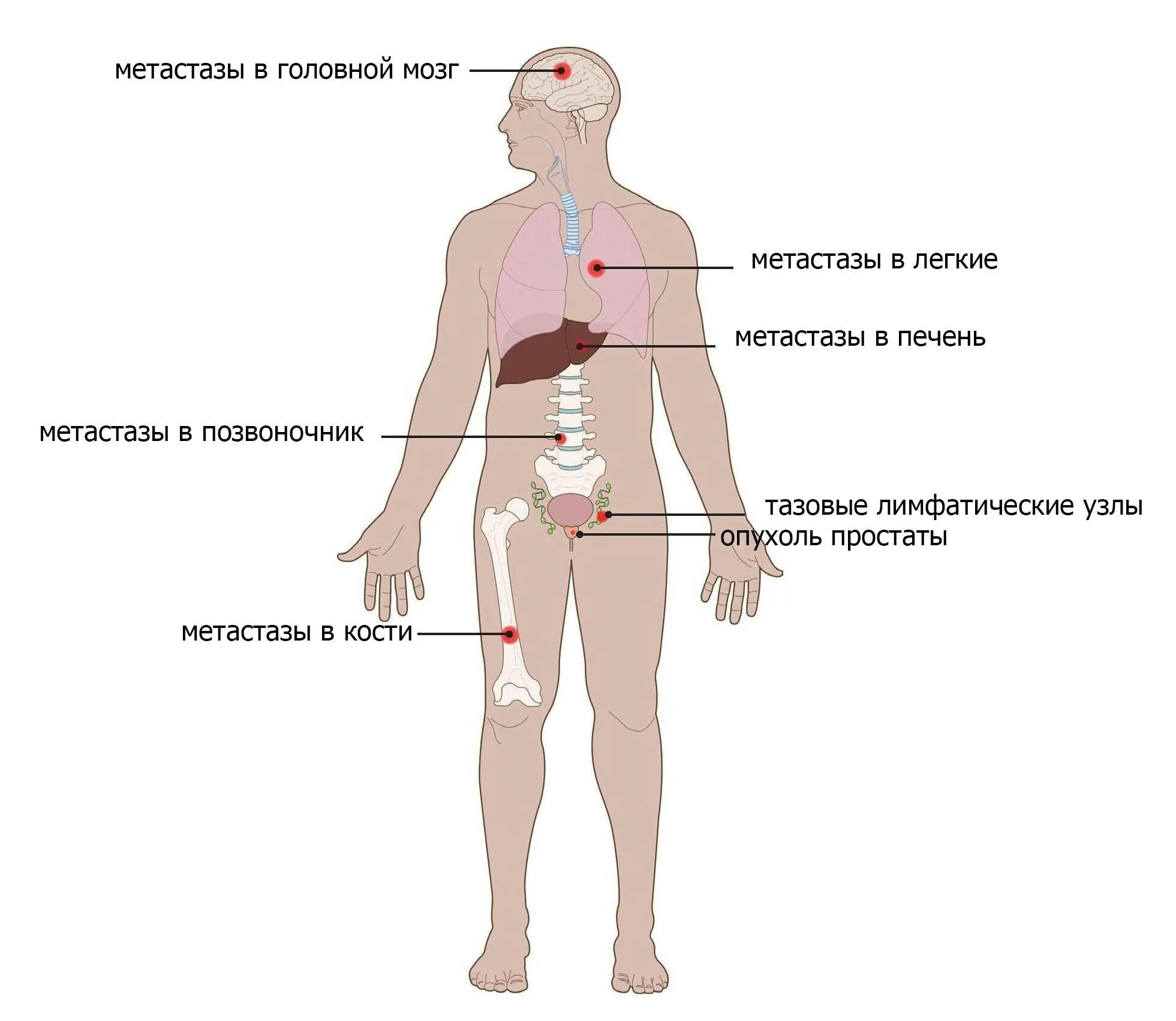 Метастазирующие опухоли. Метастатические лимфоузлы