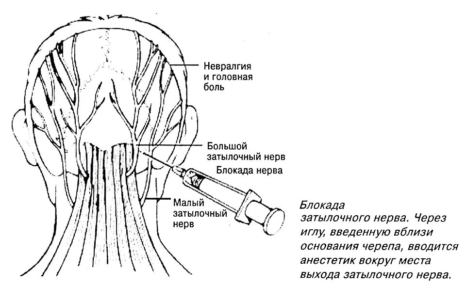 Может ли в затылке. Методика блокады большого затылочного нерва. Невропатология затылочного нерва. Блокада затылочного нерва техника.