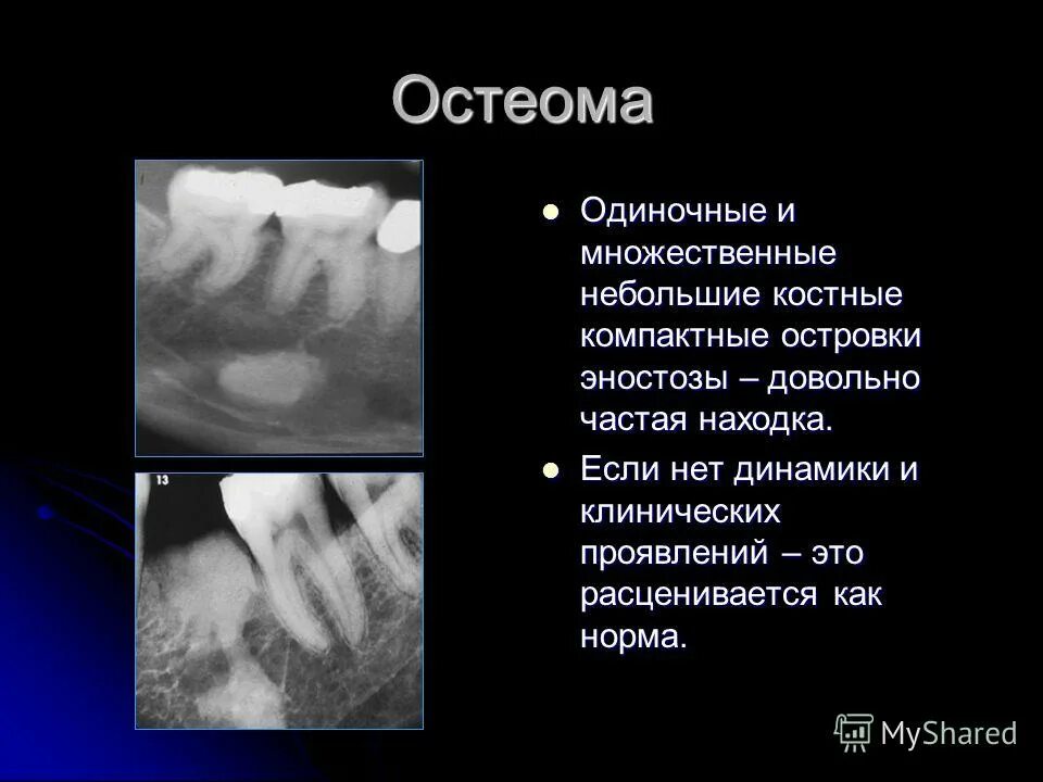 Остеоид-остеома бедренной кости. Остеома головного мозга. Остеома нижней челюсти рентген. Губчатая остеома черепа. Остеома остеоид бедренной кости операция.