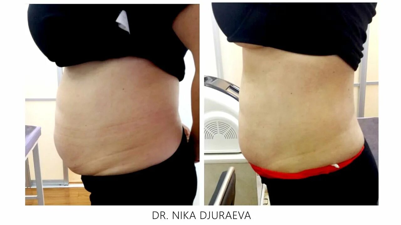 ультразвуковая липосакция живота. лазерная кавитация липолиз. кавитация процедура до и после. кавитация живота отзывы. кавитация живота отзывы.