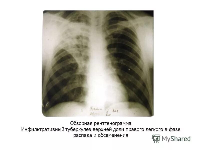 Инфильтративный туберкулез легкого. Инфильтративный туберкулез легких в фазе уплотнения. Инфильтративный туберкулез верхней доли рентген. Туберкулез острый инфильтративный. Инфильтративный распад легких