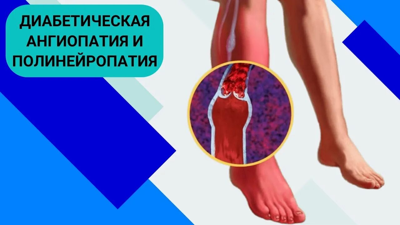 Симптомы диабетической ангиопатии. Симптомы диабетической ангиопатии. Морфология диабетической микроангиопатии. Симптомы диабетической ангиопатии. Сахарный диабет ретинопатии.