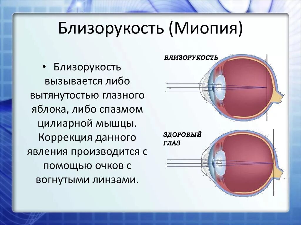 Болезнь дальнозоркость. Миопия. Близорукость миопия. Близорукость глазное яблоко.