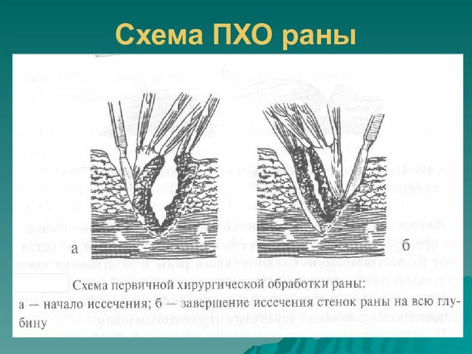 Первичная хирургическая обработка это. Первичная хирургия обработка РАН. Первичная хирургическая обработка раны стадии. Этапы выполнения первичной хирургической обработки РАН.