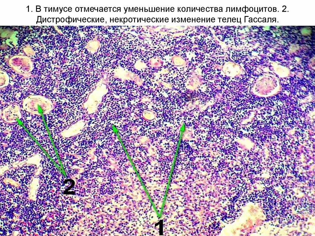 Тельца Гассаля тимус гистология. Акцидентальная инволюция тимуса гистология. Акцидентальная трансформация тимуса микропрепарат патанатомия. Акцидентальная трансформация тимуса микропрепарат. Гиперплазированные лимфоузлы