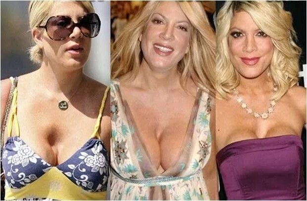 Увеличение груди до и после отзывы Breast Implants Injection 10ml Hyaluronic Acid Dermal Filler Buy Breast Implan
