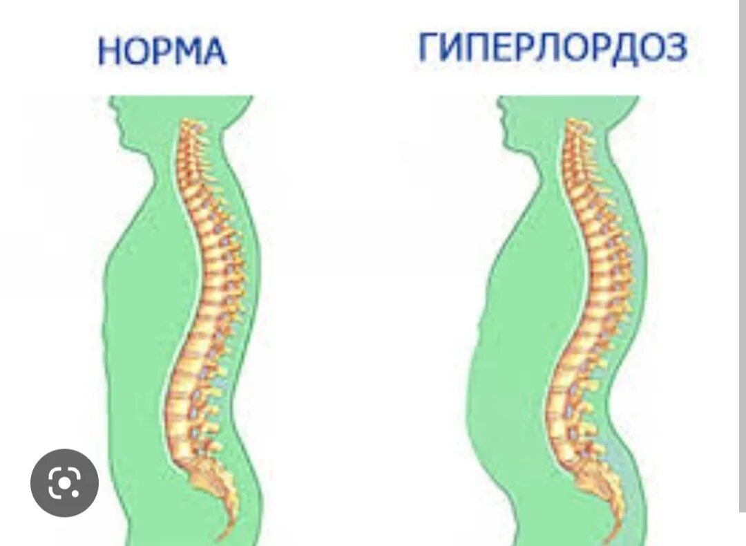 Лордоз поясничного отдела. Гиперлордоз пояснично-крестцового отдела. Лордоз и гиперлордоз. Поясничный лордоз усилен рентген. Гиперлордоз и выпирающий живот